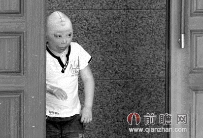 女泄憤用油澆5歲侄子 臉部大面積燒傷血肉模糊