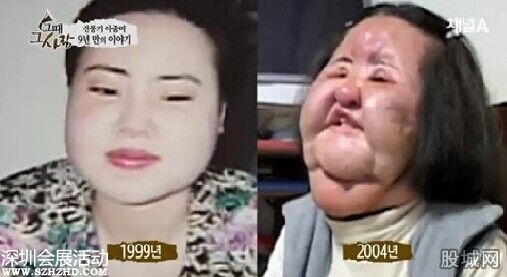 電風扇大媽臉部腫脹恐怖至極 竟是整容惹的禍