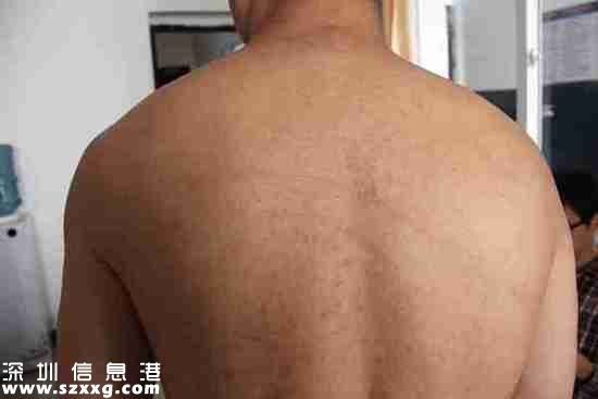 2013年4月22日，王志剛被轉送到劍閣縣看守所，重新檢查了身體狀況。照片顯示，王志剛的后背有條狀色素沉著。