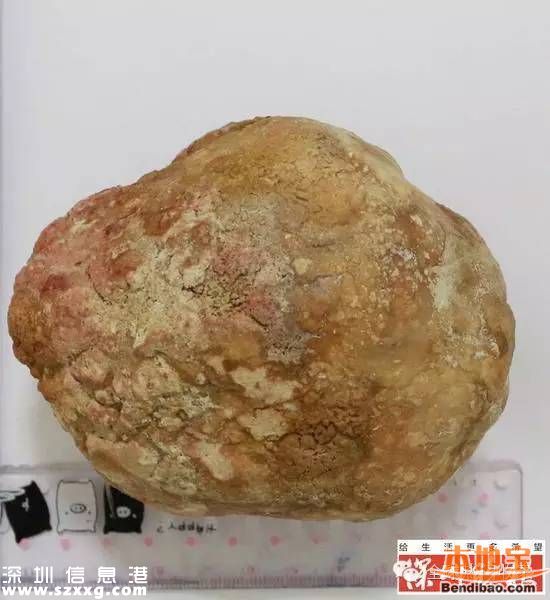 膀胱取出巨大結(jié)石 一斤重占滿整個(gè)膀胱