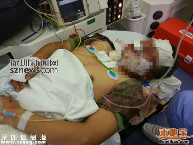 龍華電子廠火災(zāi)續(xù) 受傷消防員左眼取出碎片