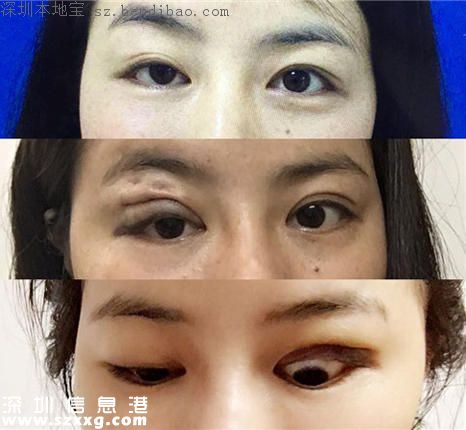 深圳女子2.6萬(wàn)做眼部整容變毀容 醫(yī)院:會(huì)慢慢恢復(fù)